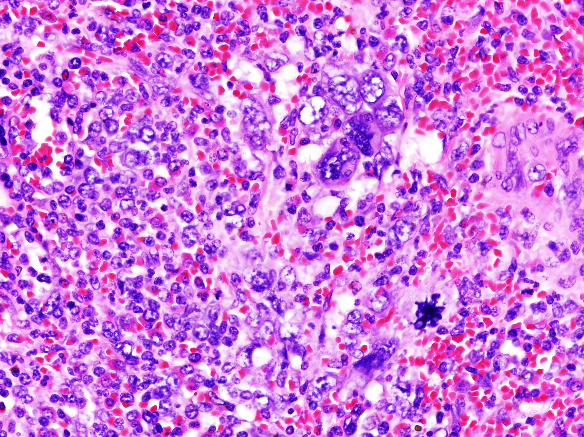 Extramedullary megakaryopoiesis surrounded by a diffuse blast cell proliferation